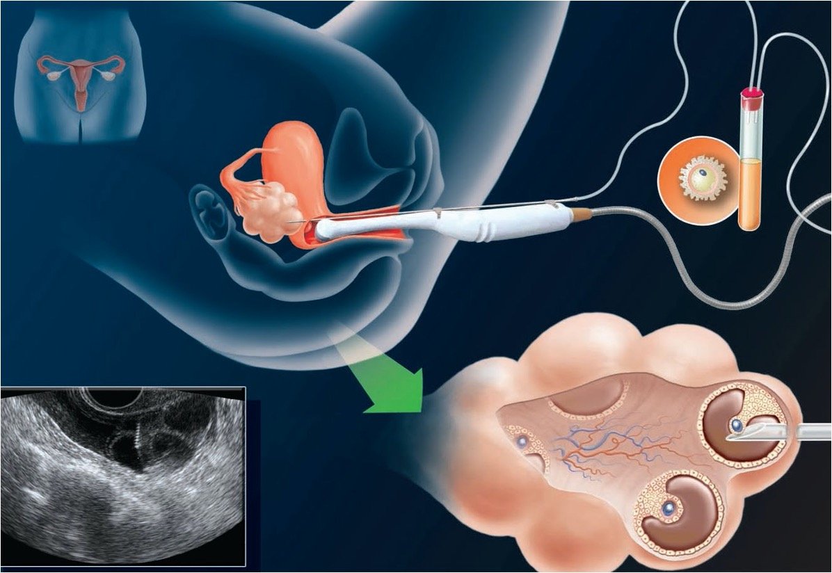 Egg Freezing: Teknologi untuk Menyimpan Cadangan Sel Telur Berkualitas